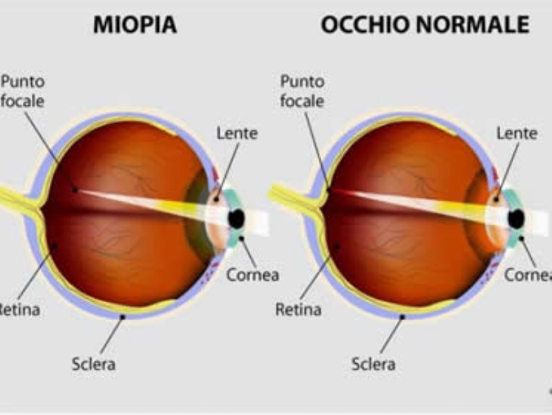 Operazione per la riduzione della miopia: l’importanza di rivolgersi a centri specializzati